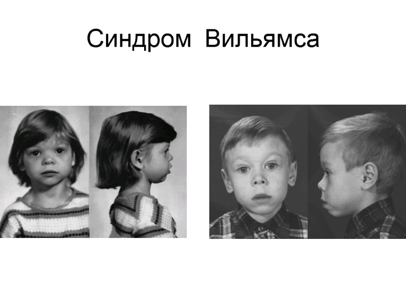 Синдром  Вильямса